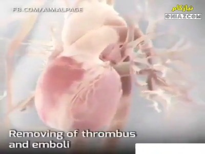 بالن زدن در رگ‌های گرفته قلب!